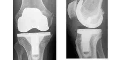 مفصل الركبة الصناعي-استبدال السطح الخارجي للعظام